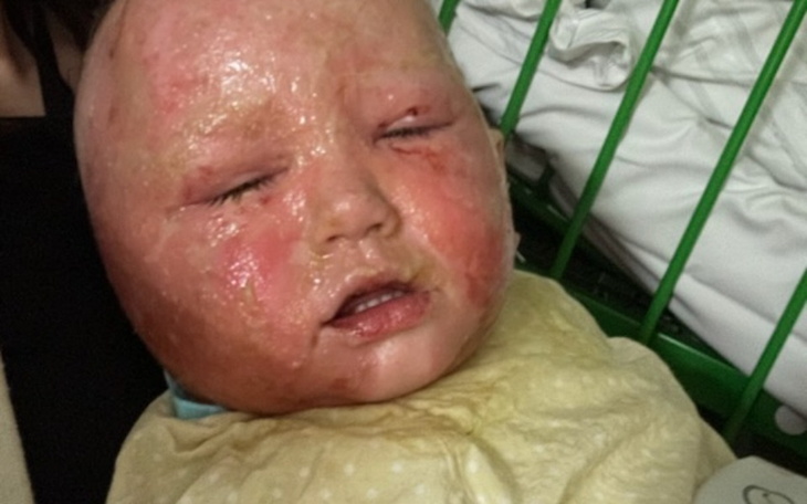 Dziecko z poparzeniami na twarzy, w trudnej sytuacji.