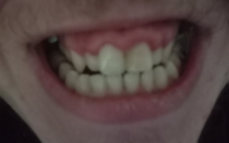 Zbiórka Zbieram na aparat do zębów - zdjęcie główne