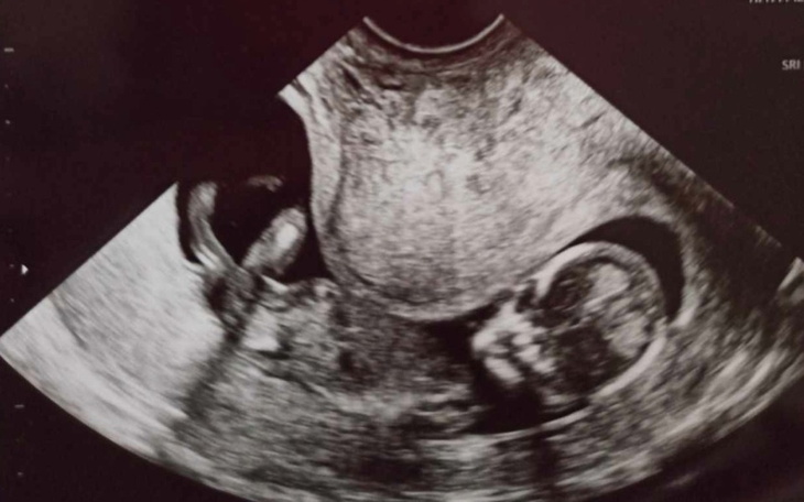 Zbiórka In Vitro dla 100 par - zdjęcie główne