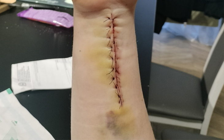 Zszyta rana na przedramieniu, widoczne szwy i siniaki.