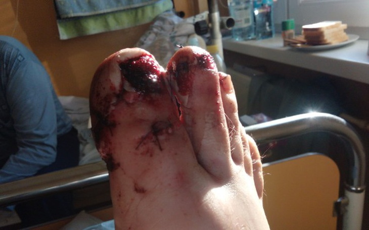 Zbiórka Zbieram na operację stopy - zdjęcie główne