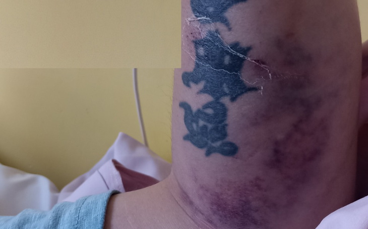 Zbiórka Na fizjoterapię męża - zdjęcie główne