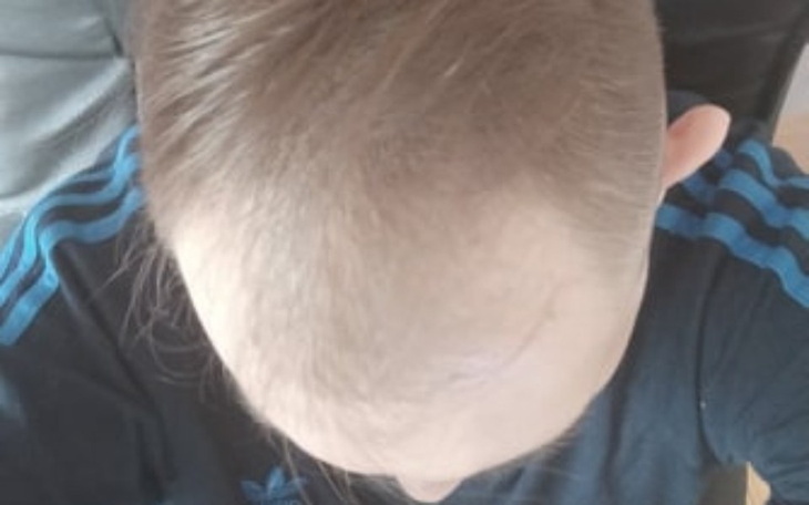 Zbiórka Przeszczep Włosów Marzenie - zdjęcie główne