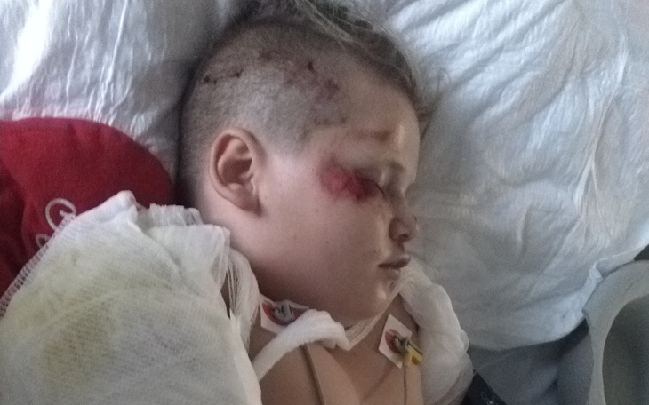 Chłopiec w szpitalnym łóżku, z ranami na głowie.