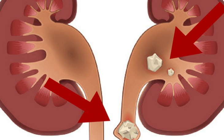 Zbiórka Usunięcie kamieni nerkowych - zdjęcie główne