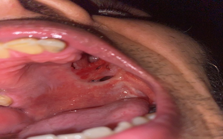 Zbiórka nowa protez górnej szczęki - zdjęcie główne