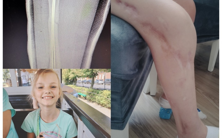 Kolaż zdjęć: uśmiechnięta dziewczynka i jej noga z bliznami.