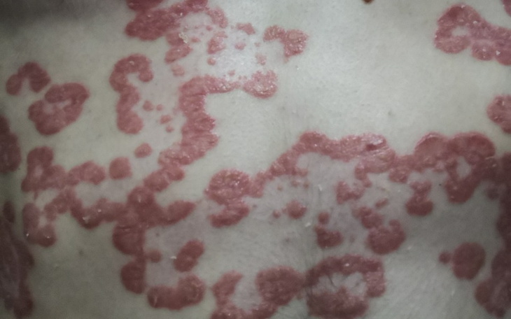 Zbiórka Leczenie Łuszczycy Biochemią - zdjęcie główne