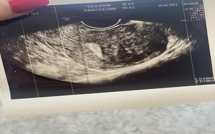 Zbiórka Embolizacja mięśniaka - zdjęcie główne