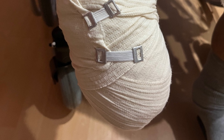 Zabandażowana noga z metalowymi klamrami.