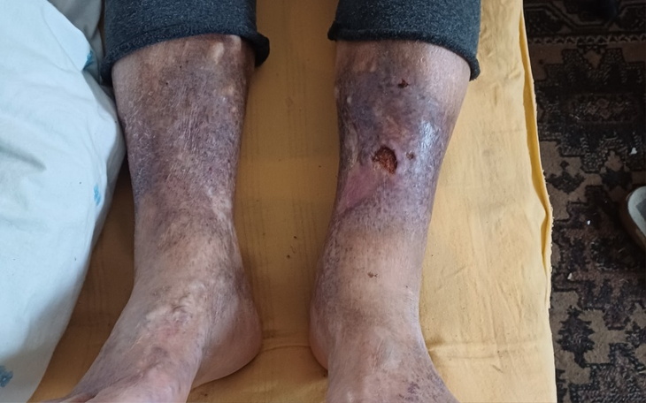 Zbiórka Leczenie , zabieg kończyn doln - zdjęcie główne