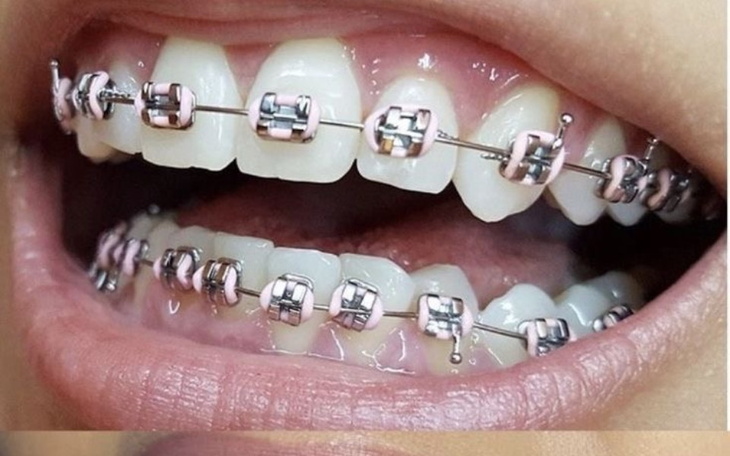 Zbiórka aparat za zeby - zdjęcie główne