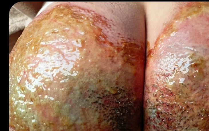 Obrazek przedstawiający oparzenia na ciele, z widocznymi ranami.