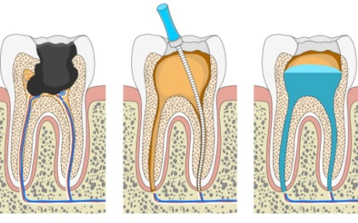 Zbiórka Naprawa zęba (leczenie kanałowe) - zdjęcie główne