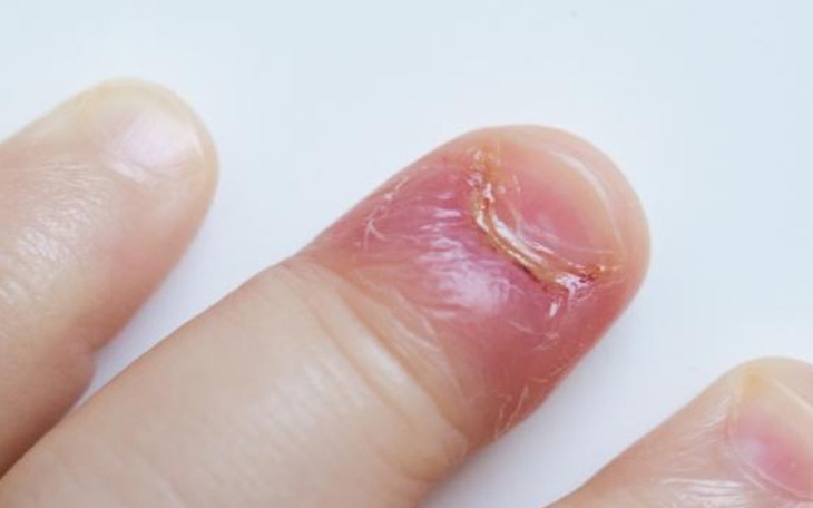 Zbiórka Na leczenie palca - zdjęcie główne