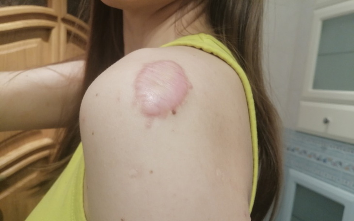 Zbiórka Leczenie bliznowca - zdjęcie główne