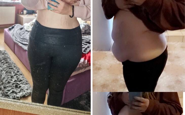 Zbiórka Plastyka brzucha,zwisająca skóra - zdjęcie główne