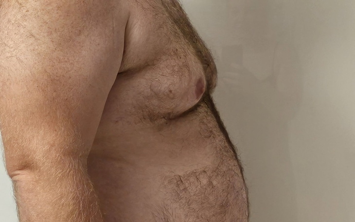 Zbiórka Na balon żołądkowy - zdjęcie główne