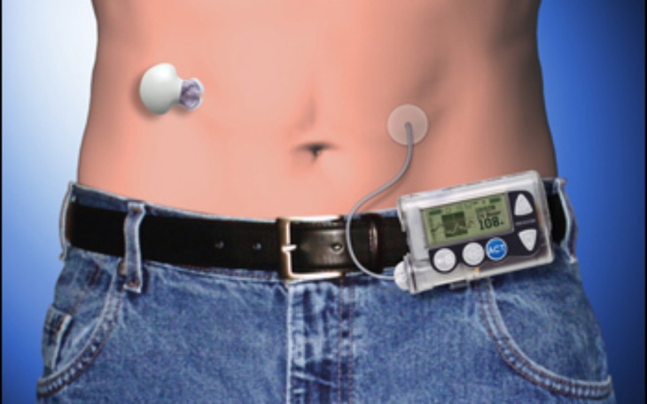 Zbiórka Zbiórka na pompę insulinowa - zdjęcie główne