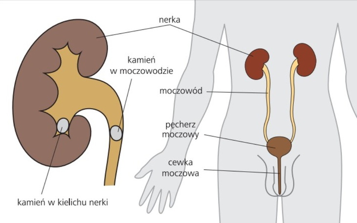 Zbiórka leczenie kamienicy nerek - zdjęcie główne