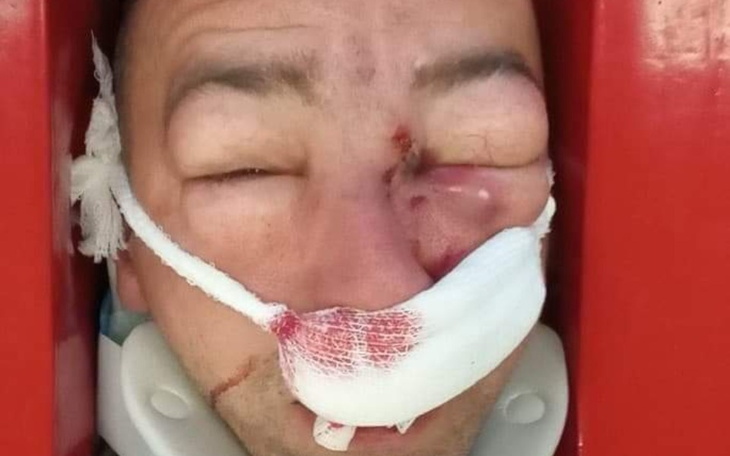 Mężczyzna z obrażeniami na twarzy, leżący na noszach.