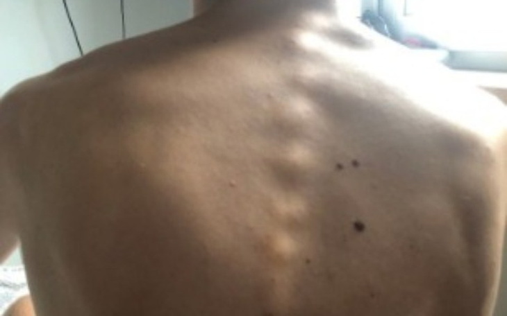 Zbiórka Poważna operacja kręgosłupa - zdjęcie główne