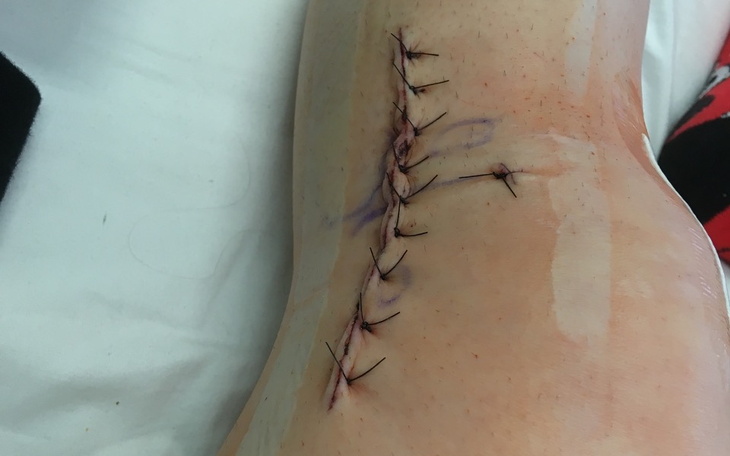 Zbiórka Na Rehabilitacje po 3 operacjach - zdjęcie główne