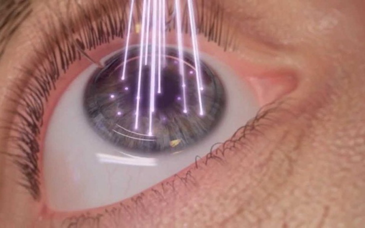 Zbiórka Korekcja obojga oczu - zdjęcie główne