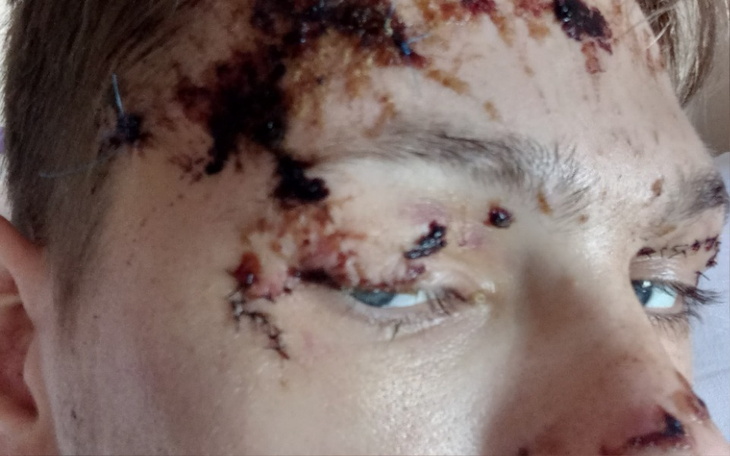 Zbiórka Na rehabilitacjie po wypadku - zdjęcie główne