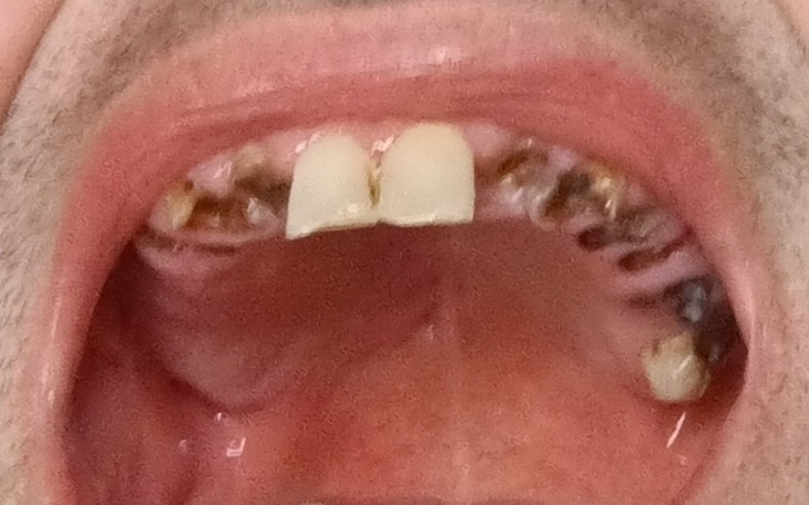 Zbliżenie na usta mężczyzny z widocznymi problemami dentystycznymi.