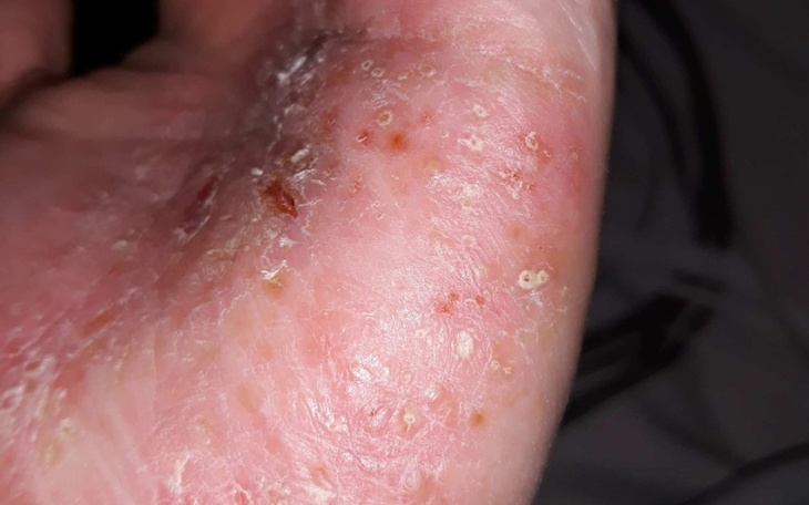 Zbiórka Egzema moja zmora - zdjęcie główne