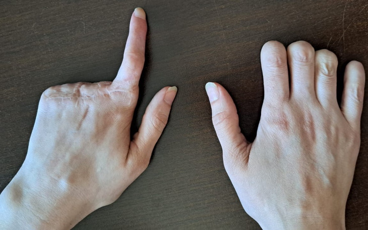 Zbiórka Protezy Palców Kobiety - zdjęcie główne