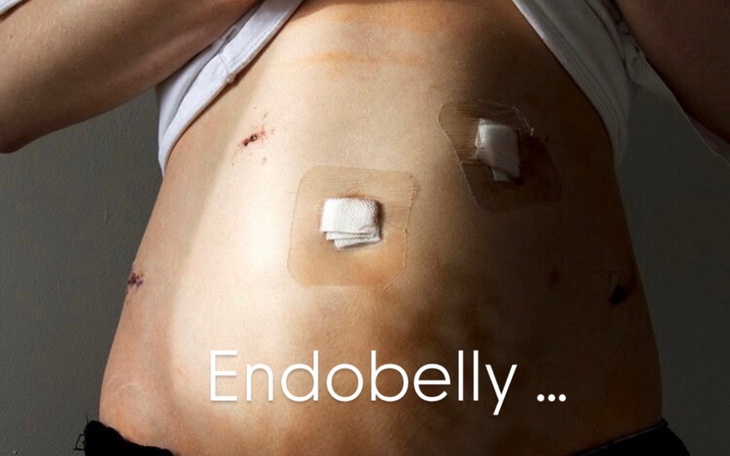 Blizny pooperacyjne na brzuchu po zabiegu.