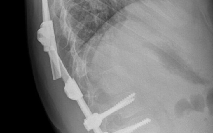 Zbiórka Znieram na gorset ortopedyczny - zdjęcie główne