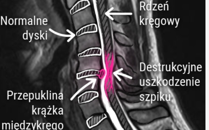 Zbiórka Na operację kręgów szyjnych - zdjęcie główne
