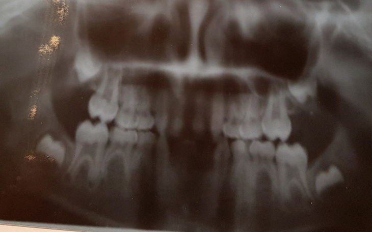 Zbiórka Wrodzona wada rozwojowa zębów - zdjęcie główne