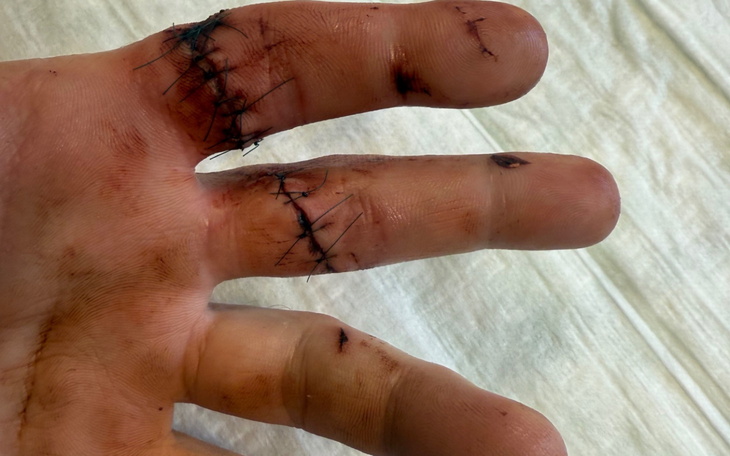 Ręka z szwami po urazie, pokazująca proces gojenia.