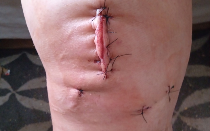 Zbiórka Leczenie dla Eweliny - zdjęcie główne