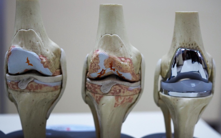 Zbiórka Endoproteza kolana - - zdjęcie główne