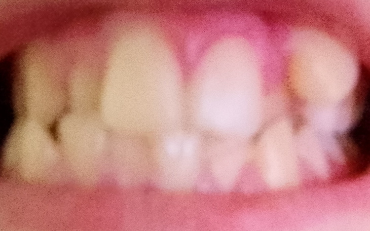 Zbliżenie na zęby, z widocznymi przebarwieniami.