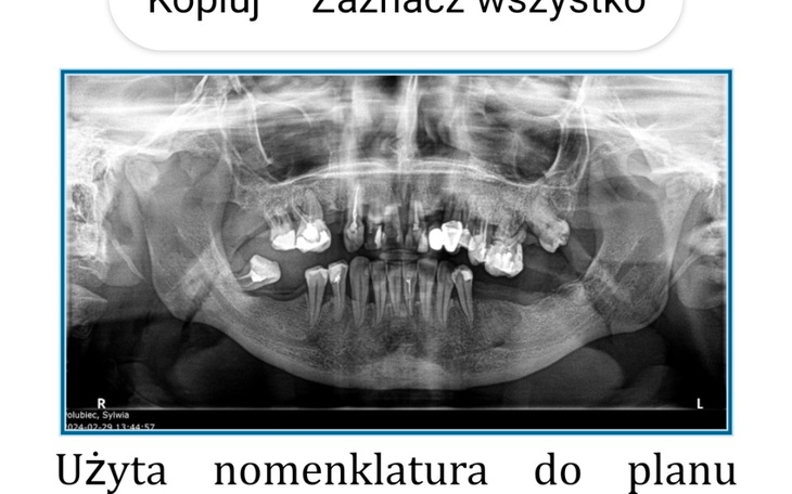 Zbiórka Proszę o pomoc w odbudowie kości - zdjęcie główne