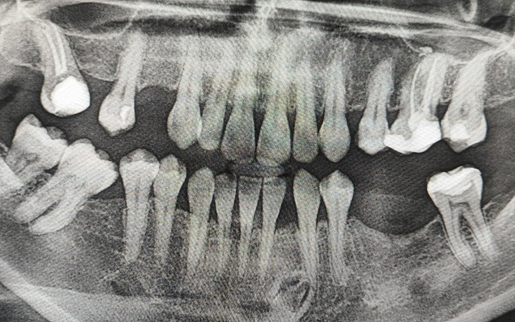 Zdjęcie rentgenowskie zębów.