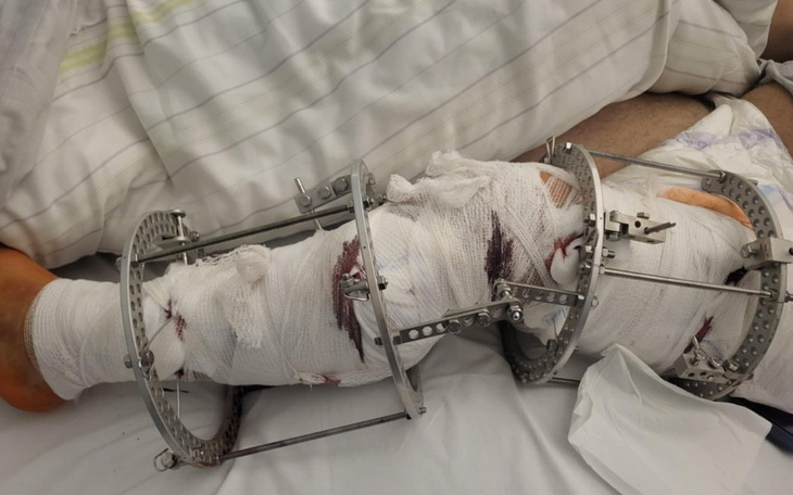 Złożona noga w opatrunkach, widok z bliska.