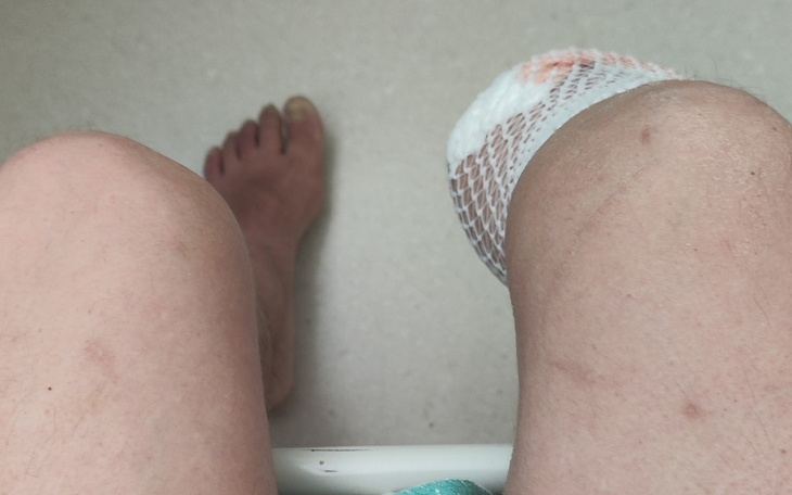 Zbiórka Zakup protezy goleniowej nogi - zdjęcie główne