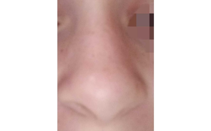 Zbiórka Korekta przegrody nosowej - zdjęcie główne