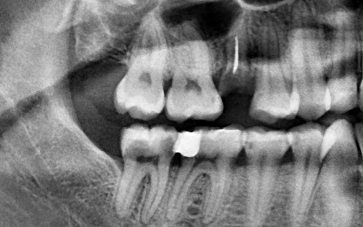 Zdjęcie rentgenowskie zębów, ukazujące ich strukturę.