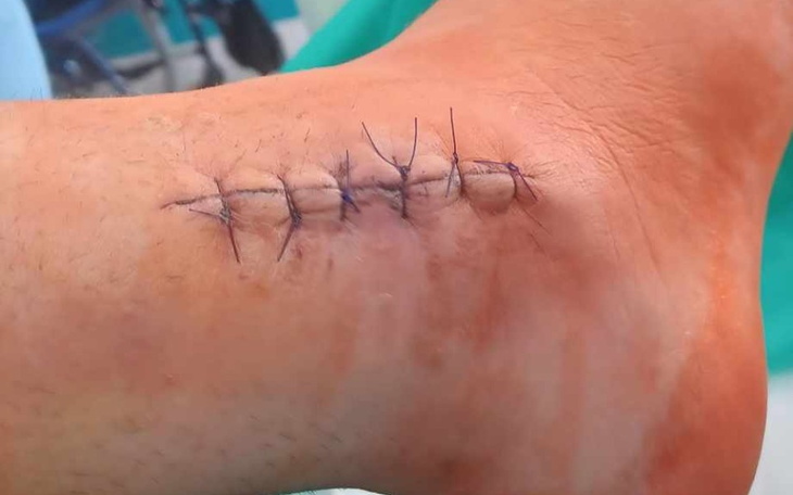 Zbiórka Rehabilitacja złamania mnogiego - zdjęcie główne