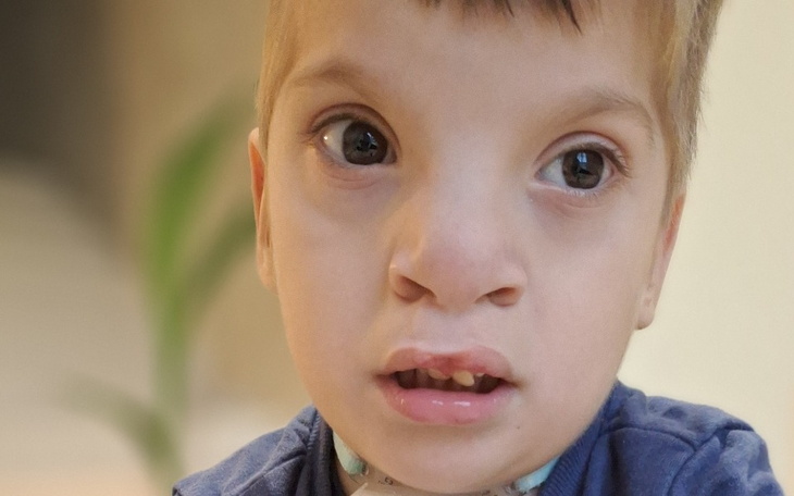 Chłopiec z nietypowymi cechami twarzy, patrzący w kamerę.
