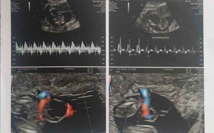 Zdjęcie USG z kolorowymi obrazami, pokazującymi rozwijające się dziecko.