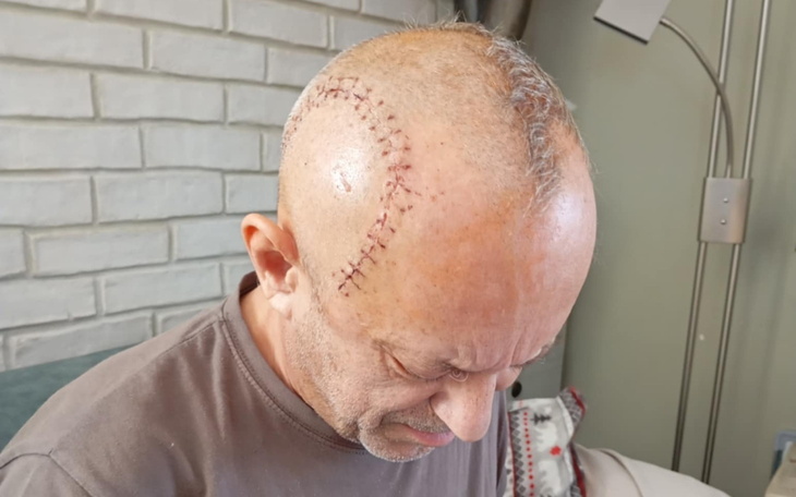 Mężczyzna z widocznymi szwami na głowie.